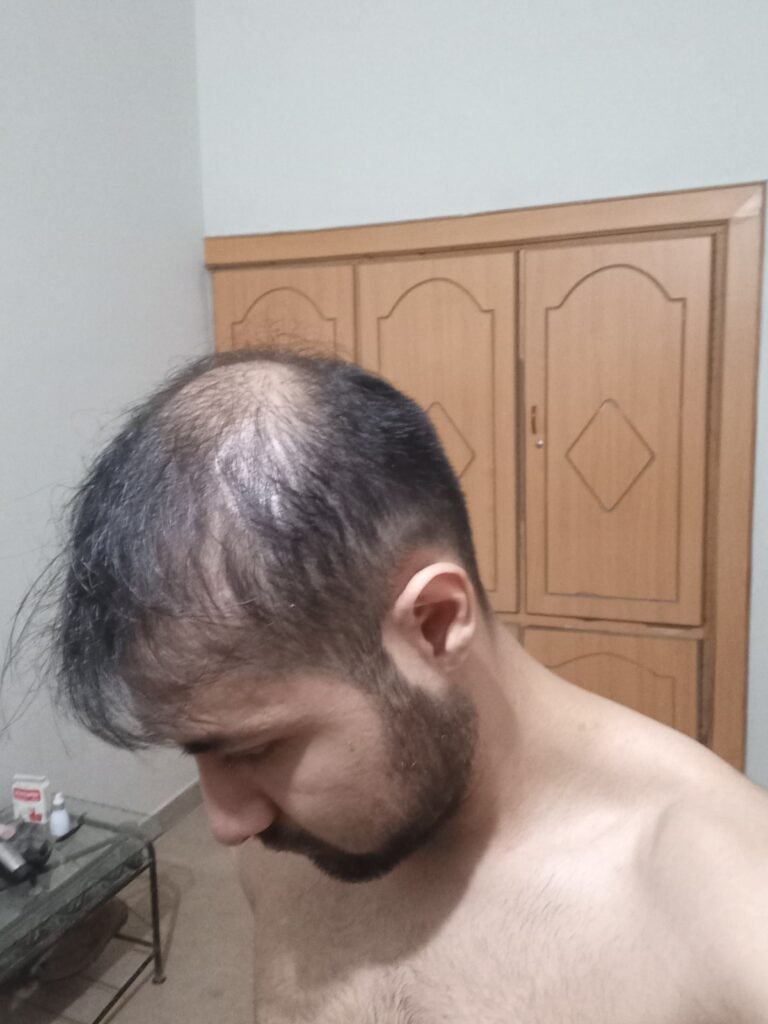 Dr. Hasnain Siraj Memon experiencing visible hair thinning Hair loss before picture while dealing finasteride side effects side view