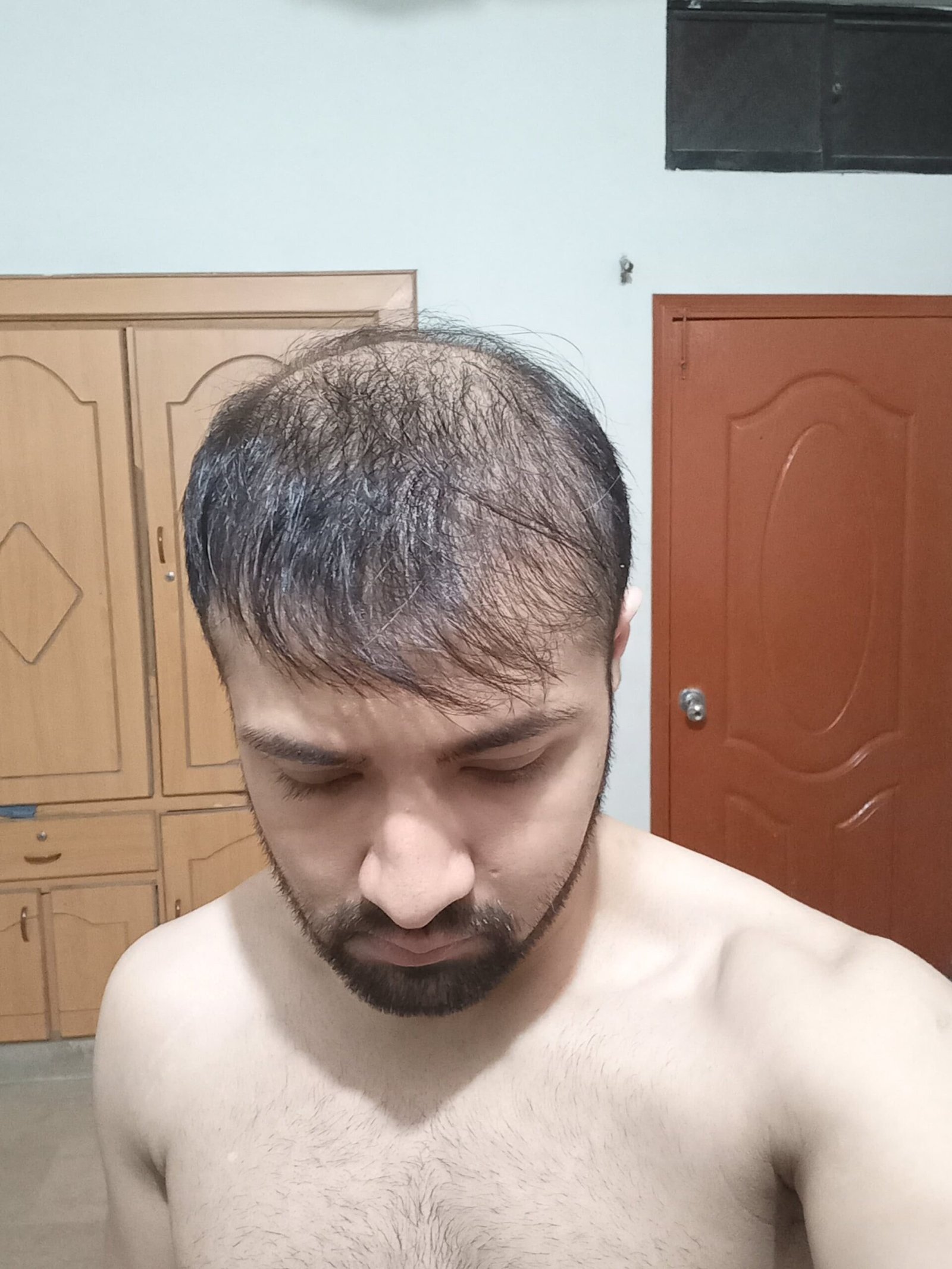 Dr. Hasnain Siraj Memon experiencing visible hair thinning Hair loss before picture while dealing finasteride side effects