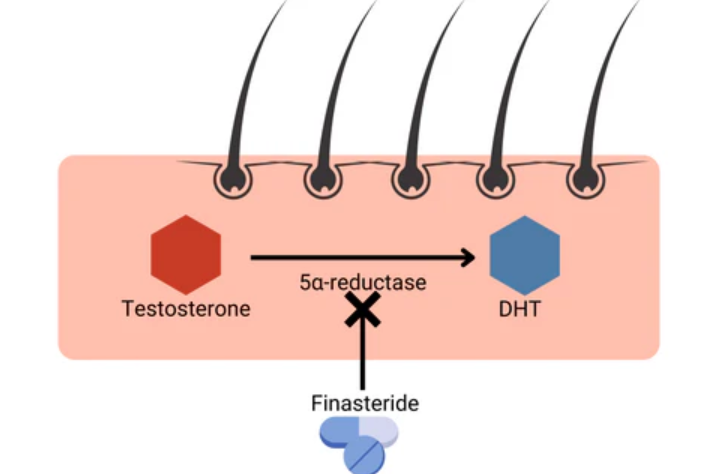 Diagram showing how finasteride blocks DHT production